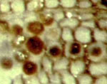 fungus clots